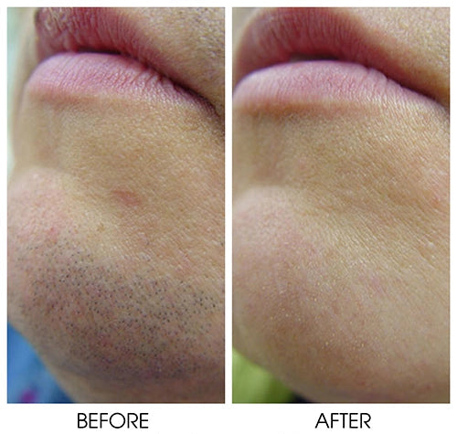 IPL Laser Hair Removal